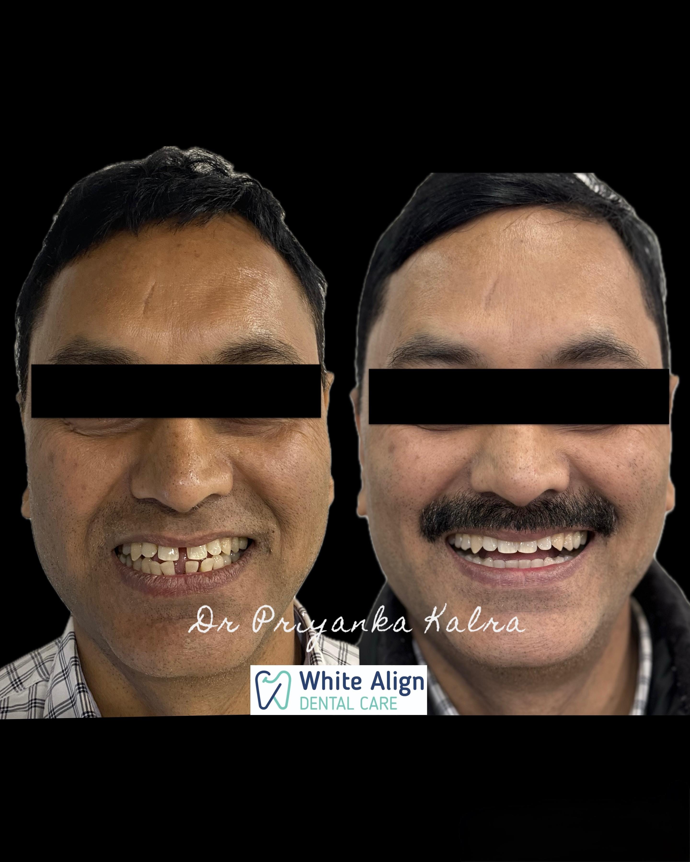 Before and after treatment result at White Align Dental Care