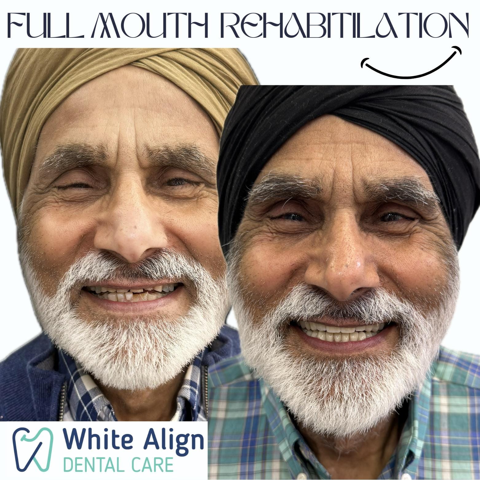 Before and after treatment result at White Align Dental Care