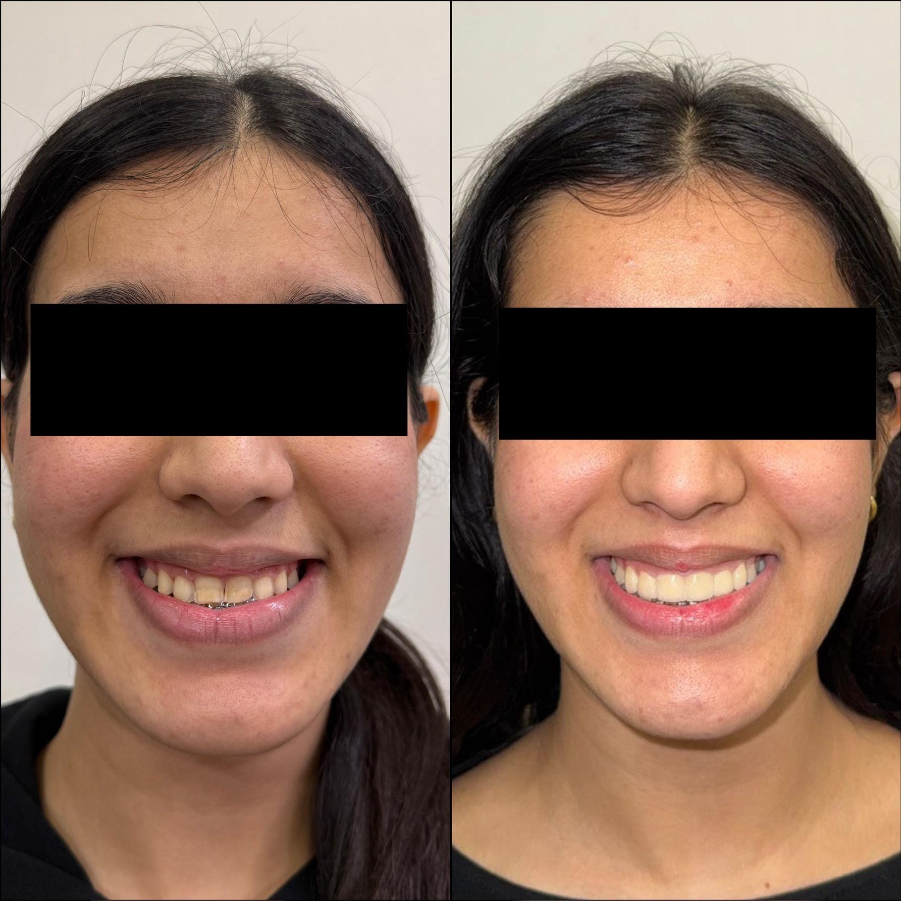 Before and after treatment result at White Align Dental Care