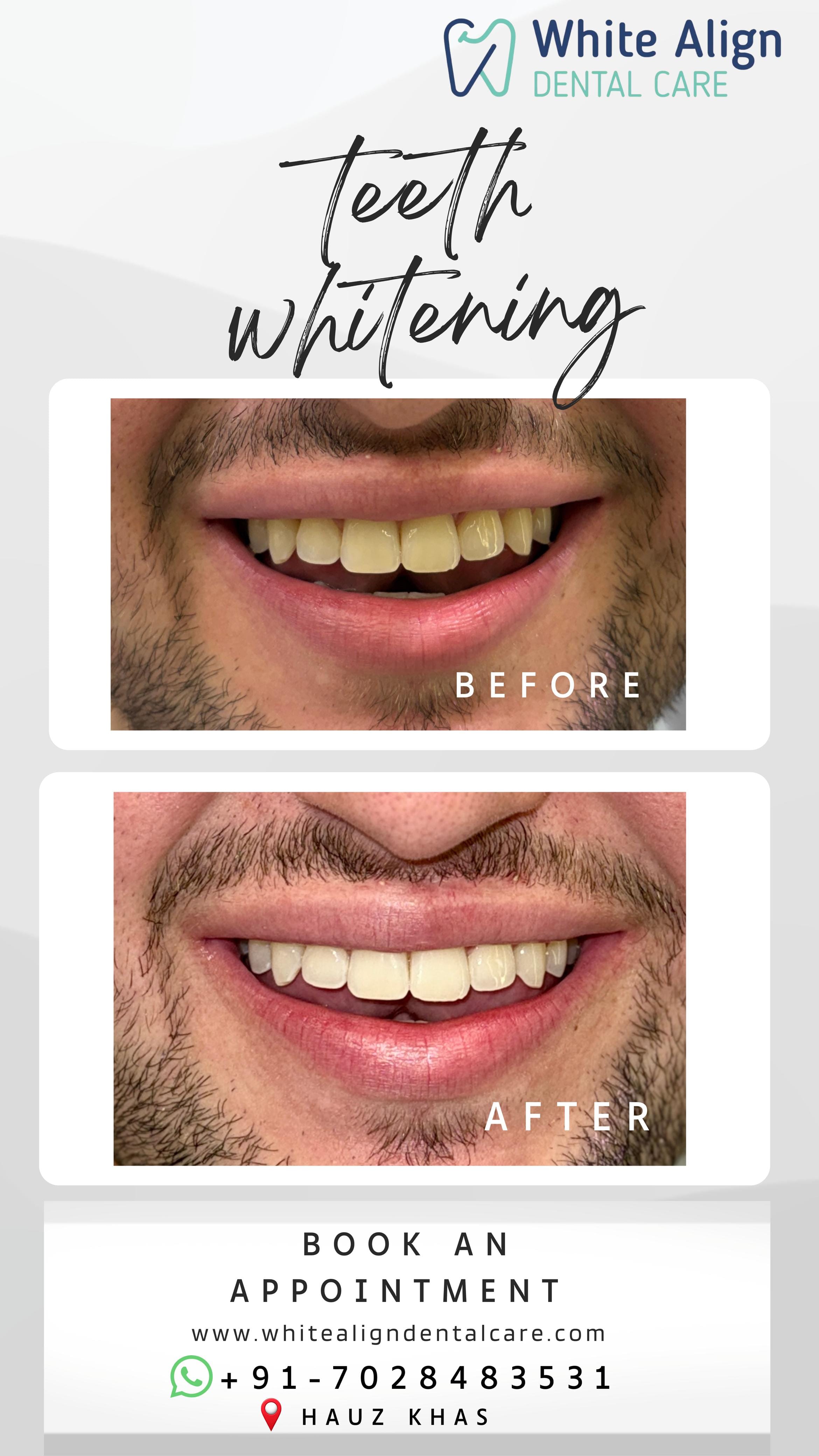 Before and after treatment result at White Align Dental Care