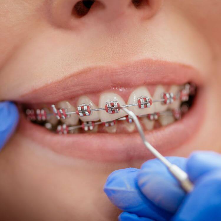 Braces