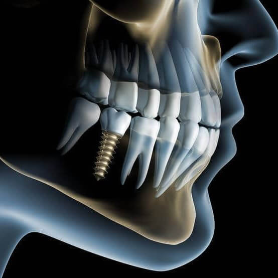 Dental Implants
