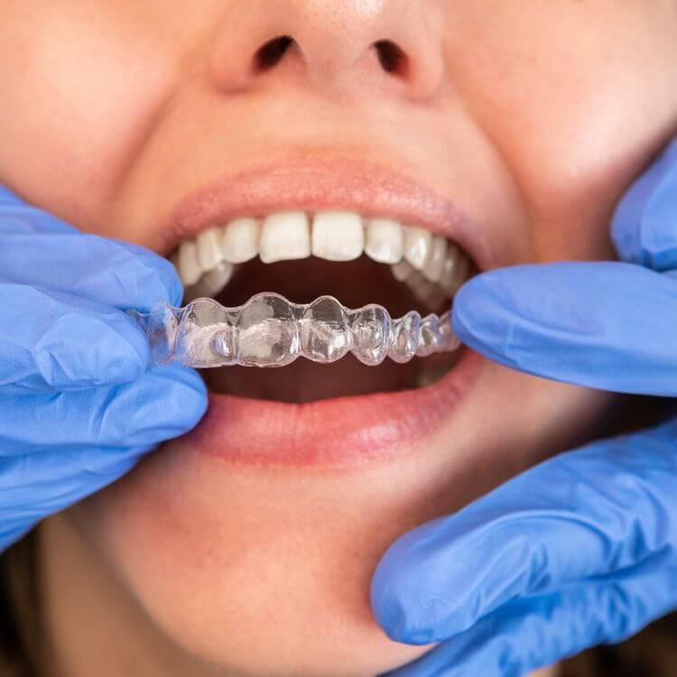 Invisalign
