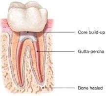 Root Canal Therapy