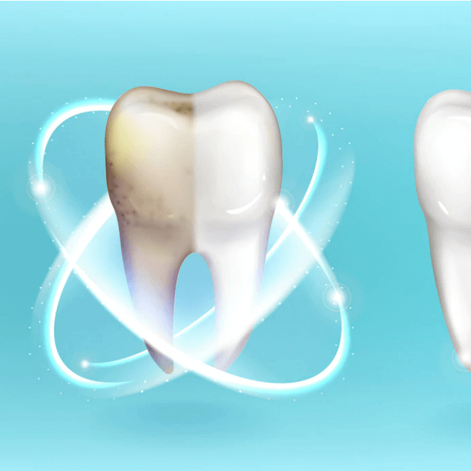 Teeth Whitening